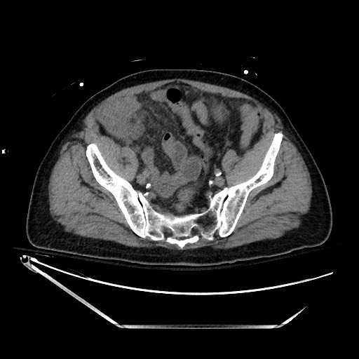 Closed loop obstruction due to adhesive band, resulting in small bowel ischemia and resection (Radiopaedia 83835-99023 Axial non-contrast 122).jpg