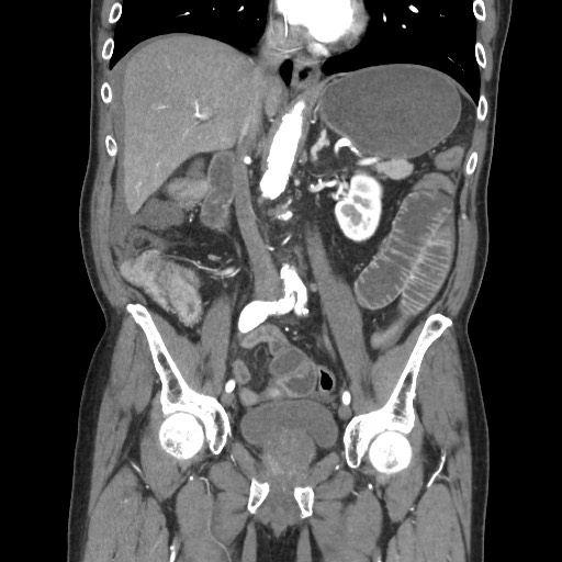 Closed loop obstruction due to adhesive band, resulting in small bowel ischemia and resection (Radiopaedia 83835-99023 C 66).jpg