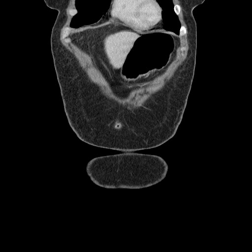 Closed loop small bowel obstruction (Radiopaedia 65403-74451 B 21).jpg