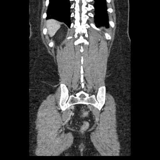 Closed loop small bowel obstruction (Radiopaedia 65403-74451 B 87).jpg
