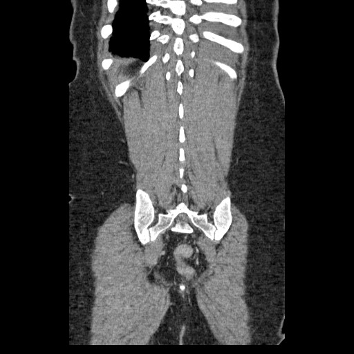File:Closed loop small bowel obstruction (Radiopaedia 65403-74451 B 90).jpg