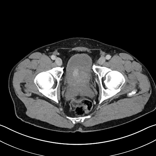 Closed loop small bowel obstruction - internal hernia (Radiopaedia 57806-64778 B 119).jpg