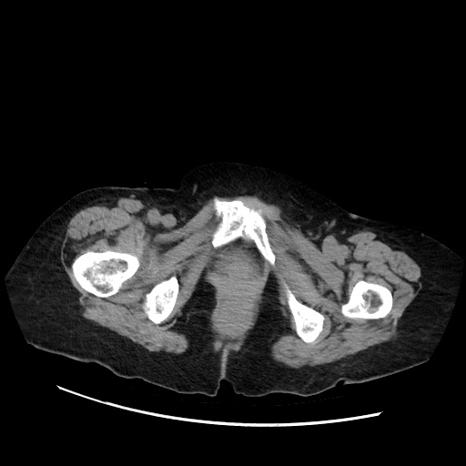 Closed loop small bowel obstruction due to adhesive band, with intramural hemorrhage and ischemia (Radiopaedia 83831-99017 Axial non-contrast 163).jpg