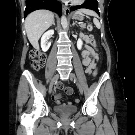 File:Closed loop small bowel obstruction due to adhesive bands - early and late images (Radiopaedia 83830-99014 B 72).jpg