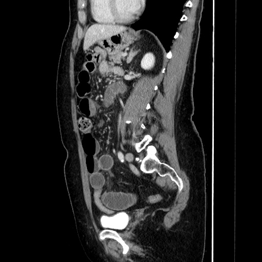 Closed loop small bowel obstruction due to adhesive bands - early and late images (Radiopaedia 83830-99015 C 108).jpg