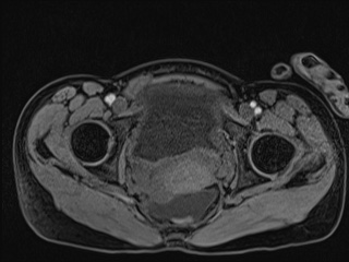 Closed loop small bowel obstruction in pregnancy (MRI) (Radiopaedia 87637-104031 G 19).jpg