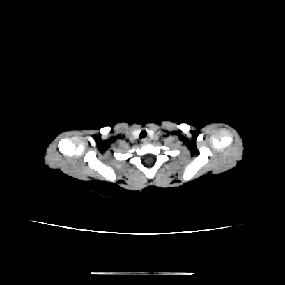 File:Cloverleaf skull (Radiopaedia 91901-109710 Axial non-contrast 6).jpg