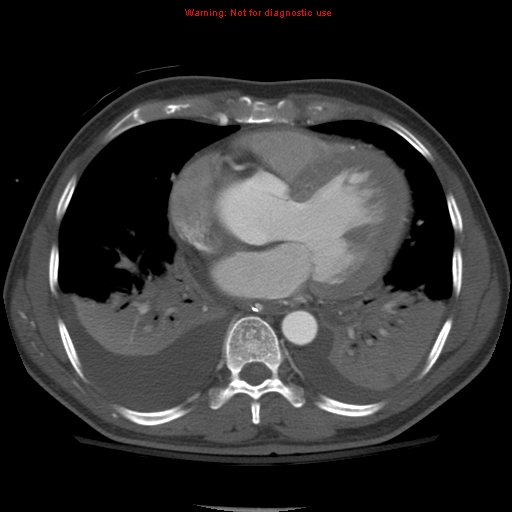File:Coarctation of the aorta (Radiopaedia 8681-9490 B 41).jpg