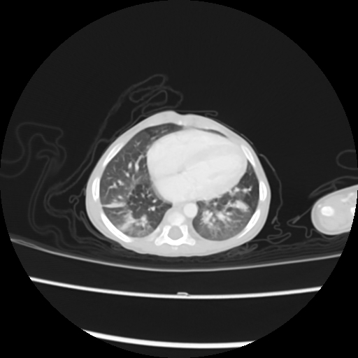 Coarctation of the aorta and patent ductus arteriosus (Radiopaedia 68033-77499 Axial lung window 42).jpg