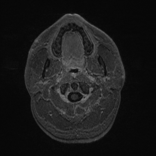 Colloid cyst (Radiopaedia 44510-48181 Axial T1 C+ 10).png