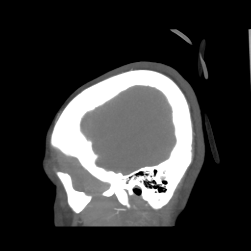 File:Colloid cyst (resulting in death) (Radiopaedia 33423-34499 B 51).png