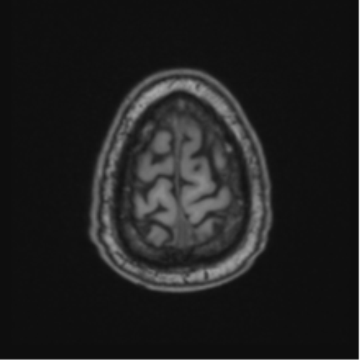 File:Colloid cyst of the third ventricle (Radiopaedia 86571-102662 Axial T1 70).png