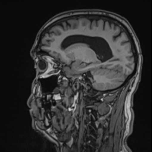 File:Colloid cyst of the third ventricle (Radiopaedia 86571-102662 Sagittal T1 28).png