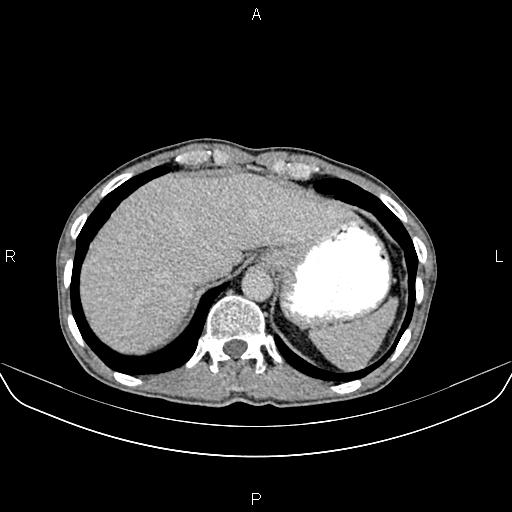 File:Colon adenocarcinoma - hepatic flexure (Radiopaedia 85635-101395 Axial C+ delayed 14).jpg
