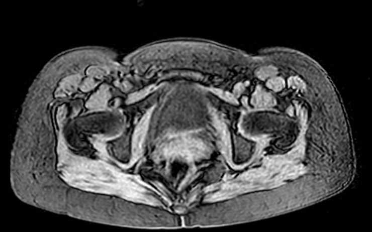 File:Colon adenocarcinoma with Krukenberg tumors, advanced pregnancy (Radiopaedia 67279-76645 A 9).jpg