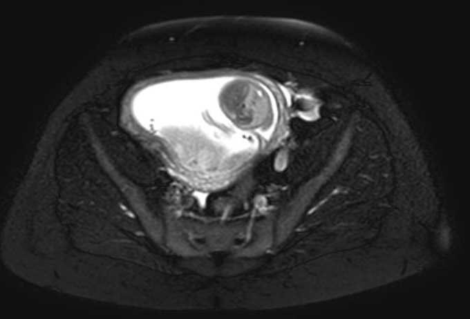 Colon adenocarcinoma with Krukenberg tumors, advanced pregnancy (Radiopaedia 67279-76645 Axial T2 SPAIR 19).jpg