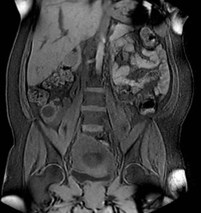 Colon adenocarcinoma with Krukenberg tumors, advanced pregnancy (Radiopaedia 67279-76645 E 50).jpg