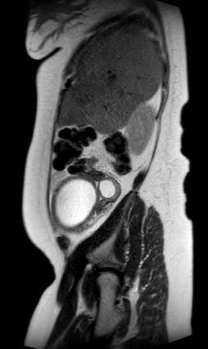 Colon adenocarcinoma with Krukenberg tumors, advanced pregnancy (Radiopaedia 67279-76645 Sagittal T2 41).jpg