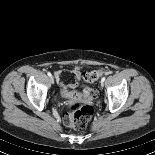 Colon carcinoma with hepatic metastases (Radiopaedia 29477-29961 A 101).jpg