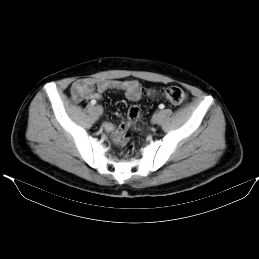 Colonic lipoma with colo-colic intussusception (Radiopaedia 58944-66200 A 54).jpg