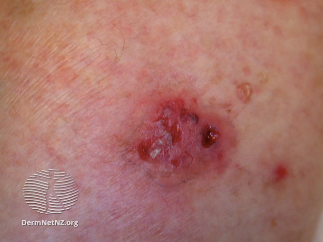 Intraepidermal carcinoma (DermNet NZ lesions-scc-in-situ-2930).jpg