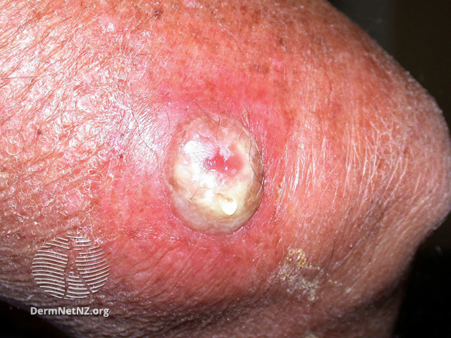 File:Intraepidermal carcinoma (DermNet NZ lesions-scc-in-situ-2968).jpg
