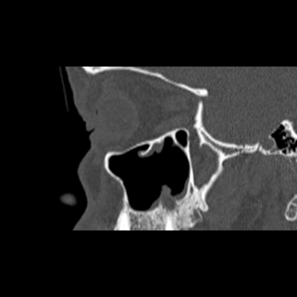 Nasal septal perforation (Radiopaedia 25030-25289 Sagittal bone window 1).jpg