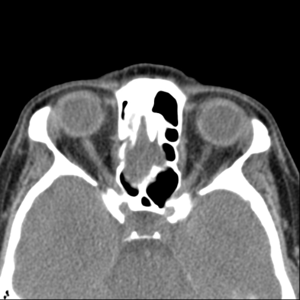 Nasolabial cyst (Radiopaedia 33987-35205 Axial non-contrast 38).jpg
