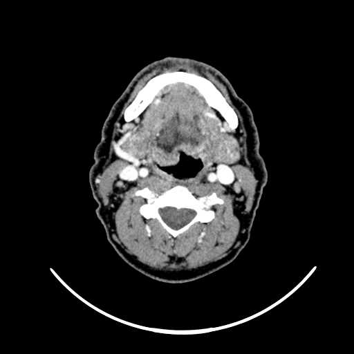 File:Nasopharyngeal carcinoma - infiltrating the clivus (Radiopaedia 62583-70875 Axial Post contrast 40).jpg