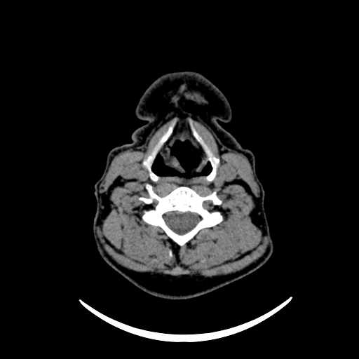 File:Nasopharyngeal carcinoma - infiltrating the clivus (Radiopaedia 62583-70875 Axial non-contrast 49).jpg