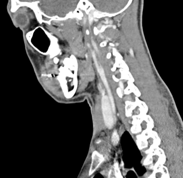 Nasopharyngeal carcinoma with skull base invasion (Radiopaedia 53415-59705 C 22).jpg