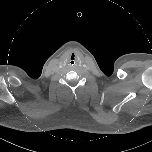 Neck CT angiogram (intraosseous vascular access) (Radiopaedia 55481-61945 B 155).jpg