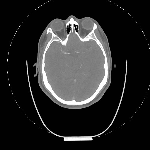 Neck CT angiogram (intraosseous vascular access) (Radiopaedia 55481-61945 B 299).jpg