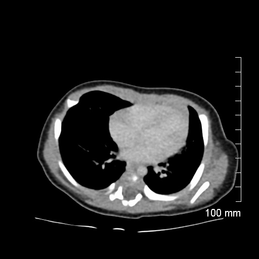 File:Neonatal neuroblastoma (Radiopaedia 56651-63438 Axial non-contrast 5).jpg