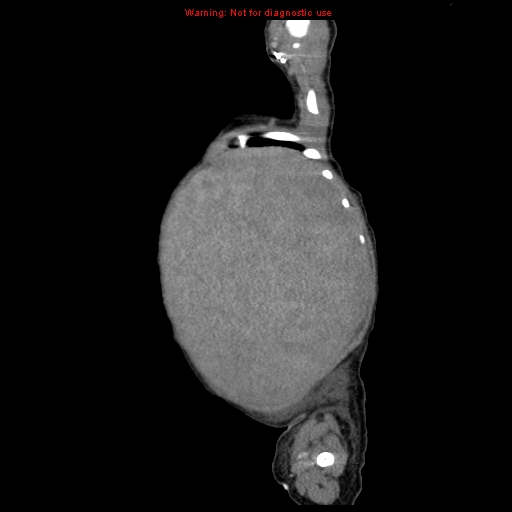 File:Neonatal neuroblastoma (Radiopaedia 9564-10223 C 24).jpg