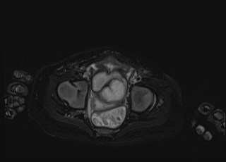Neonatal prostatic utricle abscess - cyst (Radiopaedia 69511-79394 Axial T2 fat sat 17).jpg