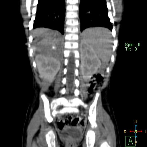 File:Neuroblastoma (Radiopaedia 24751-25016 B 19).jpg