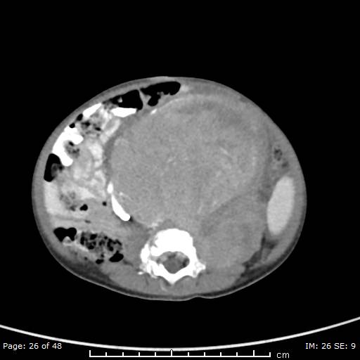 File:Neuroblastoma (Radiopaedia 41472-44355 A 26).jpg
