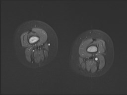 File:Neuroblastoma with bone metastases (Radiopaedia 67080-76414 Axial STIR 17).jpg