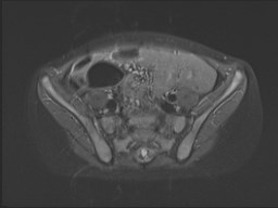 File:Neuroblastoma with bone metastases (Radiopaedia 67080-76414 Axial STIR 58).jpg