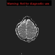 File:Neurofibromatosis type 1 with optic nerve glioma (Radiopaedia 16288-15965 Axial ADC 3).jpg