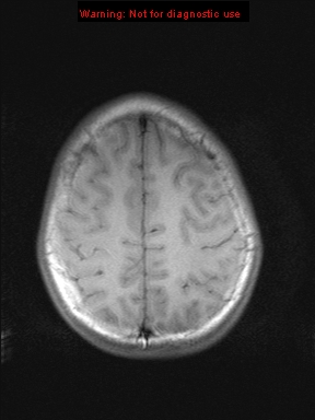 File:Neurofibromatosis type 1 with optic nerve glioma (Radiopaedia 16288-15965 Axial T1 5).jpg
