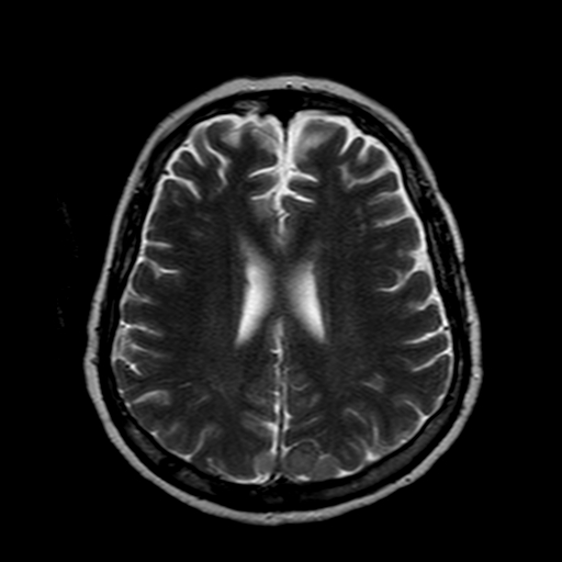 File:Neurofibromatosis type 2 (Radiopaedia 8713-9518 Axial T2 9).jpg