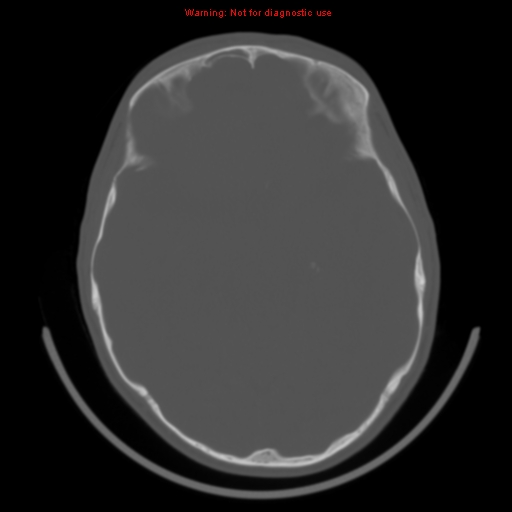 File:Neurofibromatosis type 2 (Radiopaedia 8953-9732 Axial bone window 16).jpg