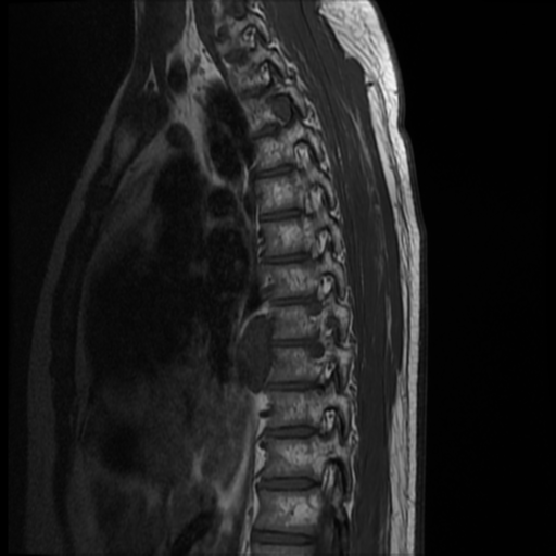 File:Neurofibromatosis type 2 (spinal manifestations) (Radiopaedia 53943-60070 D 10).png