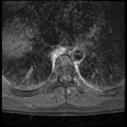 File:Neurofibromatosis type 2 (spinal manifestations) (Radiopaedia 53943-60070 J 18).png