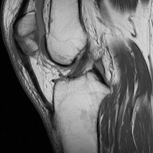 File:Non-displaced patella fracture (Radiopaedia 15932-15582 Sagittal T1 10).jpg