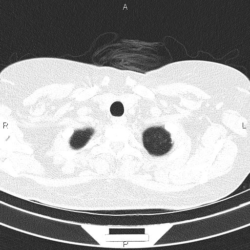 Non-specific interstitial pneumonia (Radiopaedia 83185-97567 Axial lung window 10).jpg