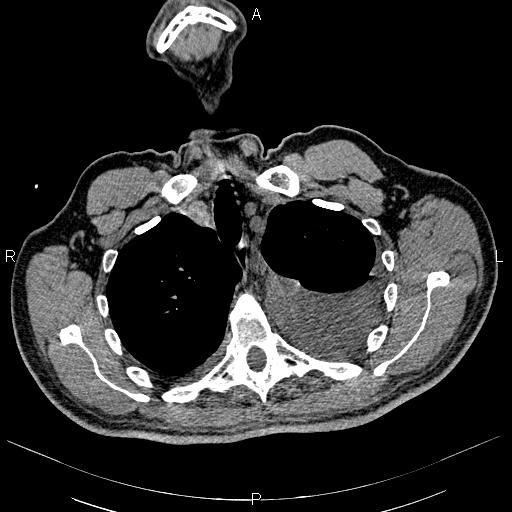File:Non Hodgkin lymphoma in a patient with ankylosing spondylitis (Radiopaedia 84323-99621 Axial non-contrast 6).jpg