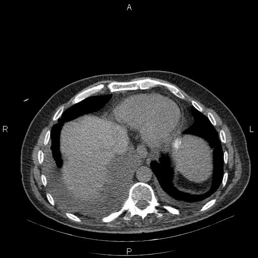 File:Non Hodgkin lymphoma in a patient with ankylosing spondylitis (Radiopaedia 84323-99624 Axial non-contrast 27).jpg